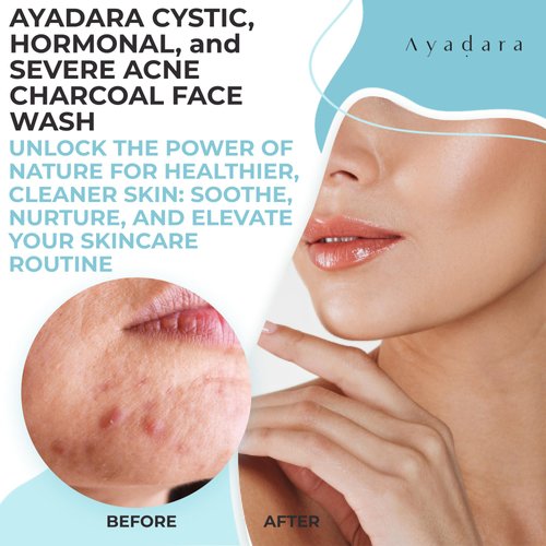 AYADARA Severe Acne Charcoal Face Wash, 3.4 oz, Daily Face Wash with Sulfur and Honey, Charcoal Face Cleanser, Mens Face Wash for Acne, Deep Cleansing Charcoal Face Wash for Women and Men, 200 Uses