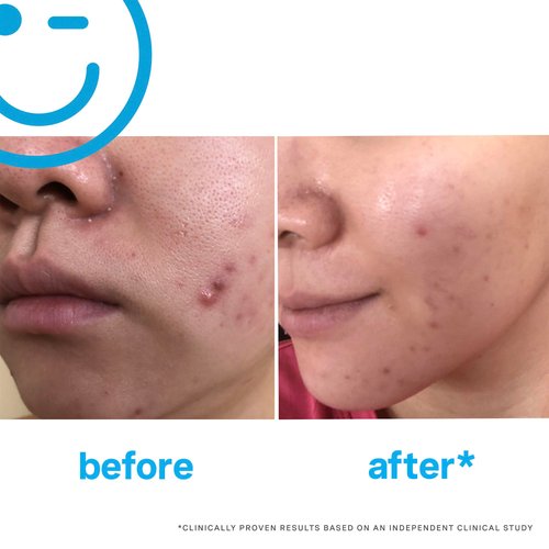 Kate Somerville EradiKate Daily Foaming Cleanser Acne Treatment - Clinically Formulated Medicated Face Wash Balances Skin and Cleans Pores, 4 Fl Oz