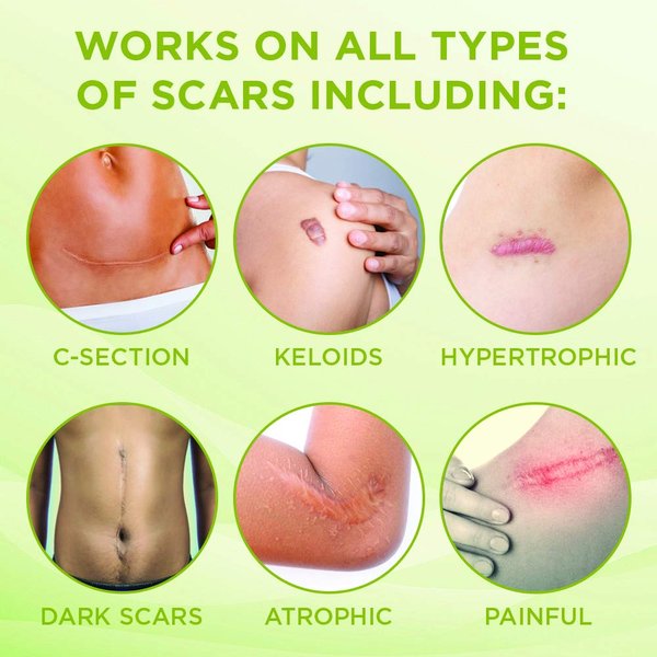KELODA Keloid Scar Care Butter Stick, Scars & Keloids Treatment Balm, For Surgical Scars & Keloids from Piercings, Stretch Marks, Acne, With Anti-Scar Cocoa, Shea Butter, Coconut, & Jojoba Oils