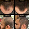 Hairline Powder by The Beard Struggle, Root Touch Up Hair Color, Hair Concealer for Men Instantly Conceals Hair Loss, Baldr's Arrow - Covers Thin Hair & Bald Spots - Sweat Resistant - Medium Brown