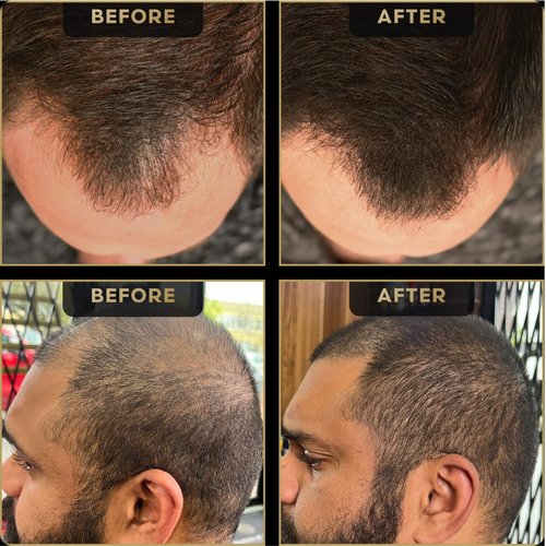 Hairline Powder by The Beard Struggle, Root Touch Up Hair Color, Hair Concealer for Men Instantly Conceals Hair Loss, Baldr's Arrow - Covers Thin Hair & Bald Spots - Sweat Resistant - Medium Brown