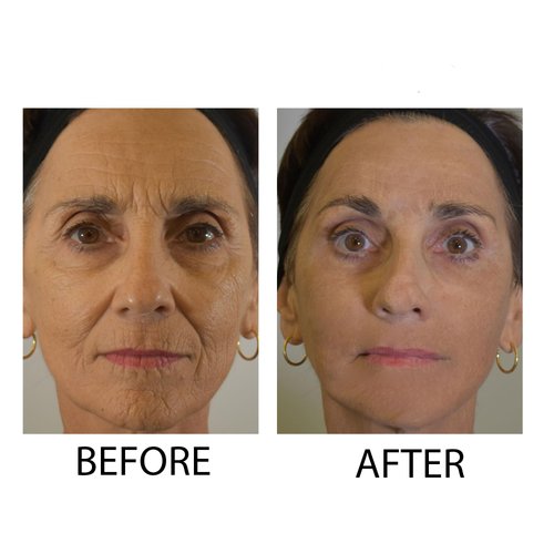 Dr.Sevinor Skincare Solutions Dr Sevinor Combo Genuine Face Lift Solution 4oz. and Wrinkle Smoothing Solution Tinted Serum 1 Fl. Oz. 2-Pack Special Save 10% Feel the Confidence! Sold by Dr.Sevinor