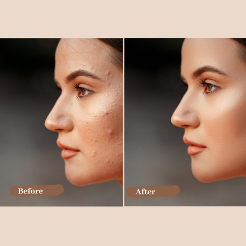 Careonic Repairing Cream with Benzoyl Peroxide & Salicylic Acid – Oil-Free, Acne Treatment & Blemish Control, 50g