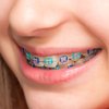 Orthodontic Ligature Ties Braces Color Bands 1040 PCS, Annhua ​Dental Orthodontic Elastomeric O-Rings Braces Rubber Bands for Braces Brackets