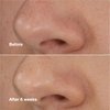 Clinique Blackhead Solutions Self-Heating Blackhead Remover With Salicylic Acid For All Skin Types, 0.68 fl. oz.