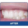 INSTANT WHITE SMILE optimized 30cc GELL ONLY syringes (NO TRAYS) 36% Professional Strength Carbamide Peroxide Teeth Whitening Gel only with Shade Card