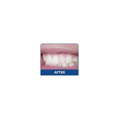 INSTANT WHITE SMILE optimized 30cc GELL ONLY syringes (NO TRAYS) 36% Professional Strength Carbamide Peroxide Teeth Whitening Gel only with Shade Card