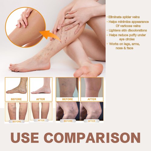 2PCS Varicose Veins Miracle Cream, Vitamin K Cream, Vein Repair Cream, Vein Massage Care, Varicose Vein Cream