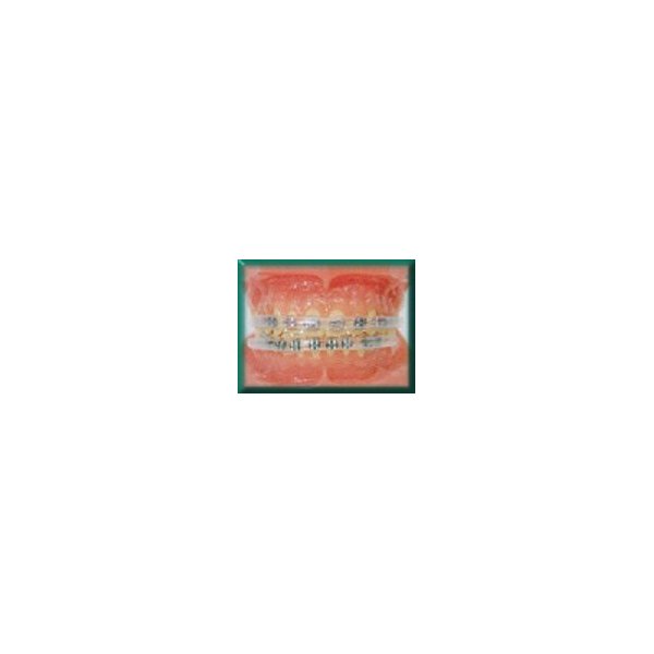 Morgan Bumper Braces Cover Lip Protector Qty 2 - Clear