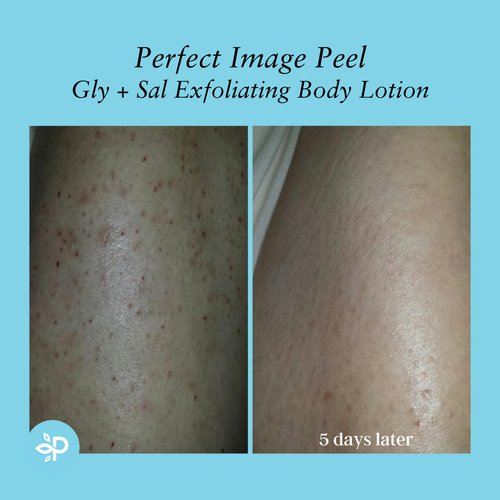 Gly + Sal Exfoliating Body Lotion, 8% Glycolic Acid and 2% Salicylic Acid Lotion Enhanced with Green Tea, Papaya, Bearberry, Licorice and Amino Complex - Perfect Image