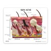 GPI Anatomicals - Skin Acne Model, Cross-Section Showing Normal and Common Acne-Riddled Skin for Human Anatomy, Physiology Education, Anatomy Model for Doctor's Office, Medical Learning Resources