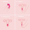 Intimina Lily Cup - Ultra-Soft Menstrual Cup, Reusable Period Protection, Thin Menstrual Cup for up to 8 Hours, Medical-Grade Silicone Women’s Period Care (B)