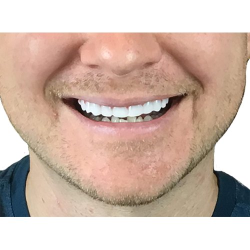 Instant Smile Flex 2pk - Bright White Shade - One Size Fits Most. Fix Your Smile at Home in Minutes! Comfortable Upper Cosmetic Veneer for A Perfect Smile!