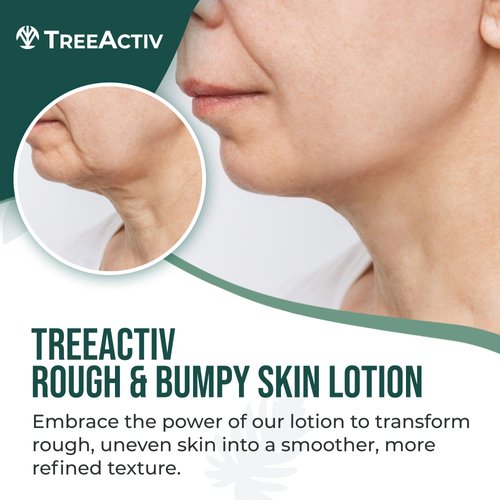 TreeActiv Rough and Bumpy Skin Lotion 8 fl oz, With Hyaluronic Acid, Shea Butter and Vitamin E, Nourishing Lotion for Rough and Bumpy Skin, Moisturizing Strawberry Legs Treatment, For All Skin Types