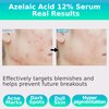 Azelaic Topical Acid 12% Serum for Face – Dark Spot Remover with Tranexamic Acid, Salicylic Acid, Niacinamide & Centella Asiatica – Acne, Hyperpigmentation & Rosacea Treatment 1 Oz Korean Skincare
