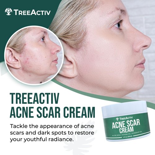 TreeActiv Acne Scar Treatment, 2 fl oz, Acne Scar Cream for Face, Gentle Acne Scars and Dark Spot Remover, Scar Lotion for Stretch Marks and Body Scars, Acne Scar Removal for All Skin Types, 500+ Uses