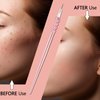 Acne Blackhead Blemish Remover Tools black head comedone extractor Pimple Popper extraction tools for estheticians (Pink)
