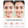 ZATKTK Acne Pimple Patch (180 Counts 4 Sizes), Invisible Hydrocolloid Acne Patch with Tea Tree Oil & Calendula Oil, Acne Spot Patch Zit Patches for Face