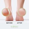 Foot Callus Remover Gel Set - Professional Callus Remover for Feet Gel - Calloused Feet Remover Gel - Pedicure Kit & Foot Spa Tools - Feet Callus Remover - 8oz w/ 16oz Tea Tree Oil Foot Soak - USA