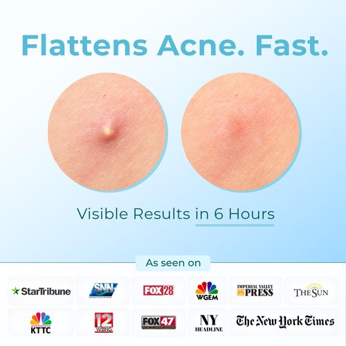 Pimple Patches (Made in Korea) for Face & Body - Overnight Treatment - Acne Patch for Zits, Bumps, Spots, Pimples, Whiteheads - Hydrocolloid Stickers - Vegan, Cruelty-Free (12mm)