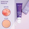 Seroflora Butt & Thighs Acne Treatment Cream - Butt Acne Clearing Cream for Pimples, Zits, Razor Bumps, Dark Spots - Acne Clearing Lotion for Buttocks & Body - Inner Thigh Blackhead Remover (4oz)