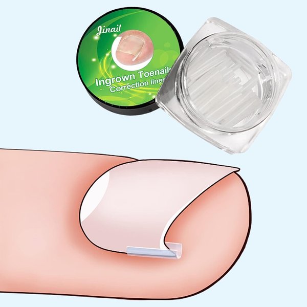 10Pcs White Ingrown Toenail Correction Strips Brace Kit, Ingrown Toenail Corrector Straightener Strips Recover Toenails Thick Pedicure Tool Toenail Straightener Strip for Ingrown Toenail Tools