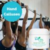 Banish My Callus Foot Callus Cream Hand Callus Remover – For Softening Rough Hard Dry Skin on Feet Hands Knees Elbows
