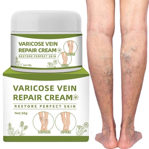 KlsyChry Varicose Veins Cream, Spider Veins Repair Cream, Varicose & Spider Veins Leg Cream, Varicose Vein Treatment Cream for Legs (50g)