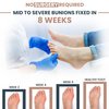 2 PCs Bunion Sleeves for Women Big Toe and Bunion Relief