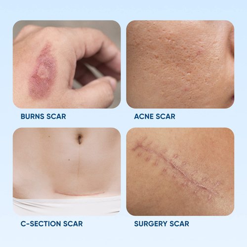 Serica Scar Gel - Silicone Scar Gel For Scar Removal - Serica Moisturizing Scar Formula - Silicone Gel For Scars - Acne Scar Treatment - Best Scar Treatment - Repair Tags - Made USA