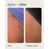Topicals High Roller Ingrown Hair Serum | Roll-on Tonic to Soothe and Calm Irritated Skin on Face, Armpits and Bikini Areas | Contains Salicylic and Glycolic Acid | Vegan and Cruelty-Free (1.7 Fl Oz)