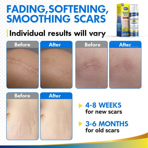 Scar Cream,Active Silicone Dimethicone Scar Gel-Advanced Repairing New Old Scars for Surgical Scars,Stretch Marks,Burn,Keloid,C-Section,Acne Treatment,1.76oz (50G)