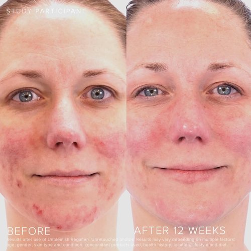 Rodan + Fields UNBLEMISH Clarifying Toner | 4.2 Fl Oz | Glycolic Acid & Hyaluronic Acid Exfoliating Facial Toner | Acne-Prone Hydrating Skincare