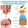 Onyxoguard Nail Growth and Repair Serum,Nail Strengthener for Thin Nail, Brittle & Damaged Strengthener Base Coat Nail Polish Repair Nail Growth Treatment, Crystal Clear