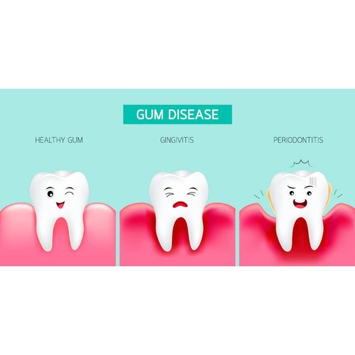 Ounce Tube (Without Boil and Bite Trays); Hydrogen Peroxide Periodontal Treatment| Oral Cleansing Gel. Mint Flavor| Promotes Teeth Whitening | Treatment for Oral HealthQ