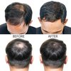 Hair-Regen Advanced 5% Minoxidil Hair Regrowth Treatment for Thinning Hair and Hair Loss for Men - 6 Month Supply, Hair Loss Treatment, Minoxidil Topical Solution So Thicker Fuller Hair Keeps Growing