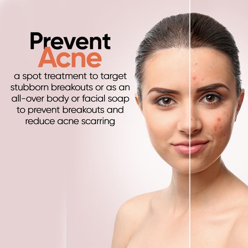 Natrulo Acne Soap Cleansing Bar for Face & Body – Black Activated Charcoal Soap with Bentonite Clay for Dry, Sensitive & Oily Skin – Black Acne Facial Cleanser for Pimples & Scars Made in USA