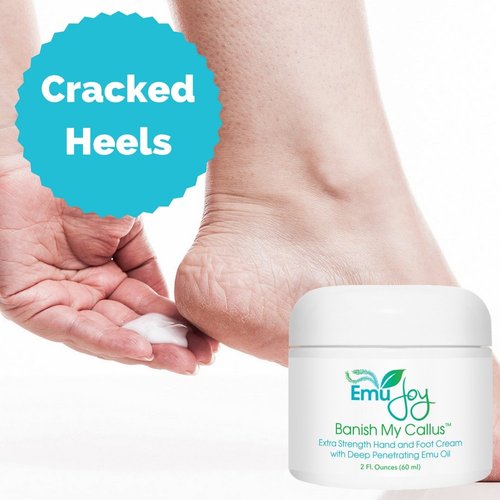 Banish My Callus Foot Callus Cream Hand Callus Remover – For Softening Rough Hard Dry Skin on Feet Hands Knees Elbows