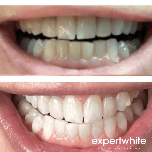 Expertwhite 22% Carbamide Peroxide Professional Dental-Grade Teeth Whitening Gel Refills for Trays - Made in USA. Peróxido de carbamida whitening gel retainer whitening gel