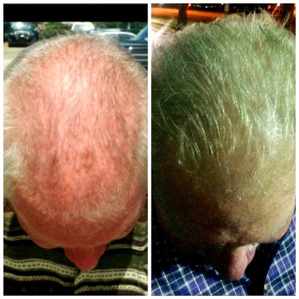 ProGrowth Scalp Treatment Hair Restoration