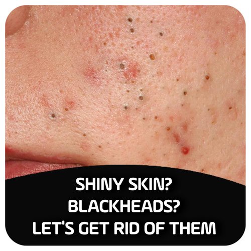 Asepxia with Activated Charcoal Purifying Effect Acne Treatment Bar Soap with Salicylic Acid, 4 Ounce