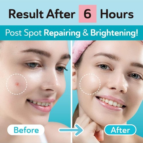 DERMA ANGEL Ultra Invisible Dark Spot Patches for Post Acne Pimple, Acne Spot Treatment - Day and Night Use - UPGRADED (Post Acne - 96 Count - 1 Size)