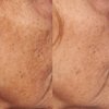 Perricone MD Vitamin C Ester Intensive Dark Spot Treatment, 1 oz.
