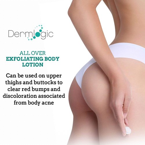 Keratosis Pilaris Treatment- Get Rid of KP, Bumps & Body Acne. 12% Lactic Acid Lotion. Moisturizing Repair Cream Smooths Rough, Dry, Cracked, Bumpy Skin & Redness.