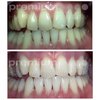 Premium Home Teeth Whitening Kit